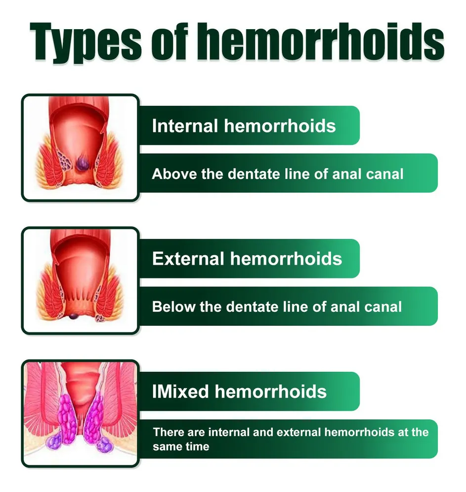 Crema Para Hemorroides